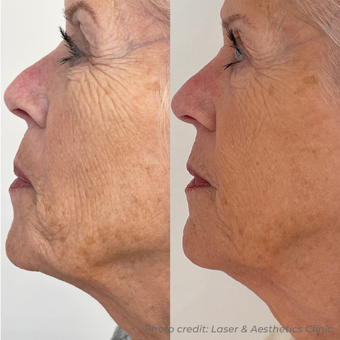 BA103_LASER&AESTHETICSCLINIC_DMF_FACE_X3_B&A