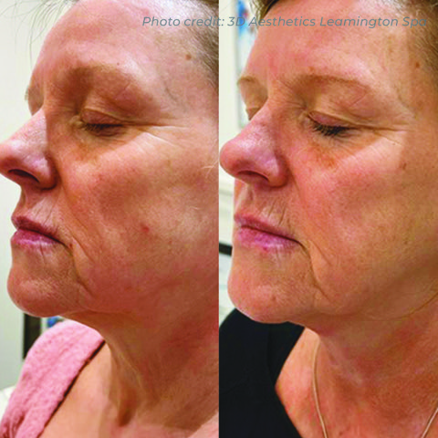 BA10_LEAMSPA_DMF_FACE_X2